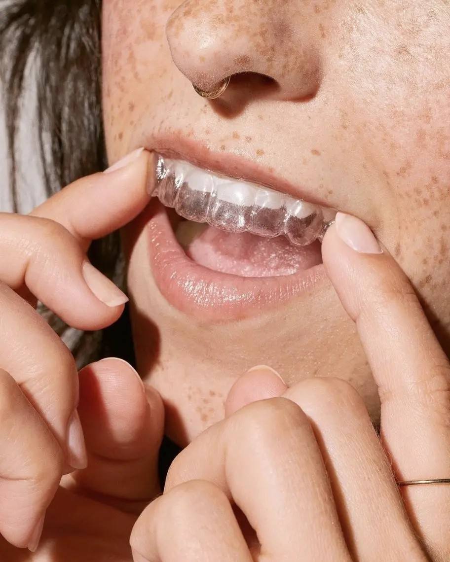 Invisalign (In-Office)